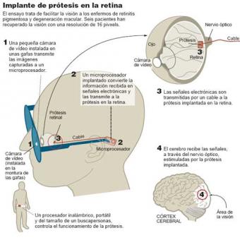 Implante_protesis_retina.jpg